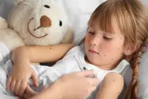 Chickenpox Treatment
