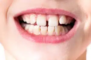 Teeth Grinding in Children
